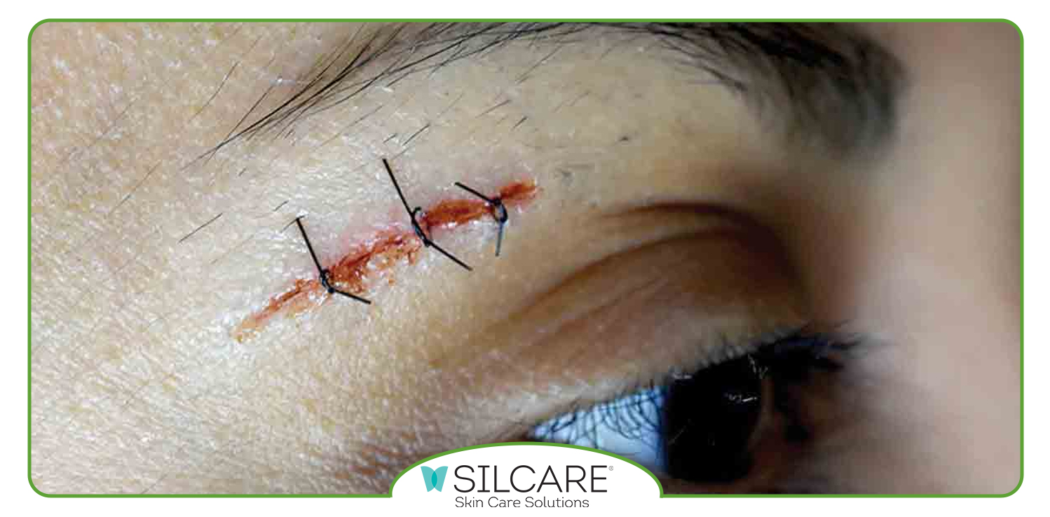 بهترین کرم ترمیم کننده جای بخیه