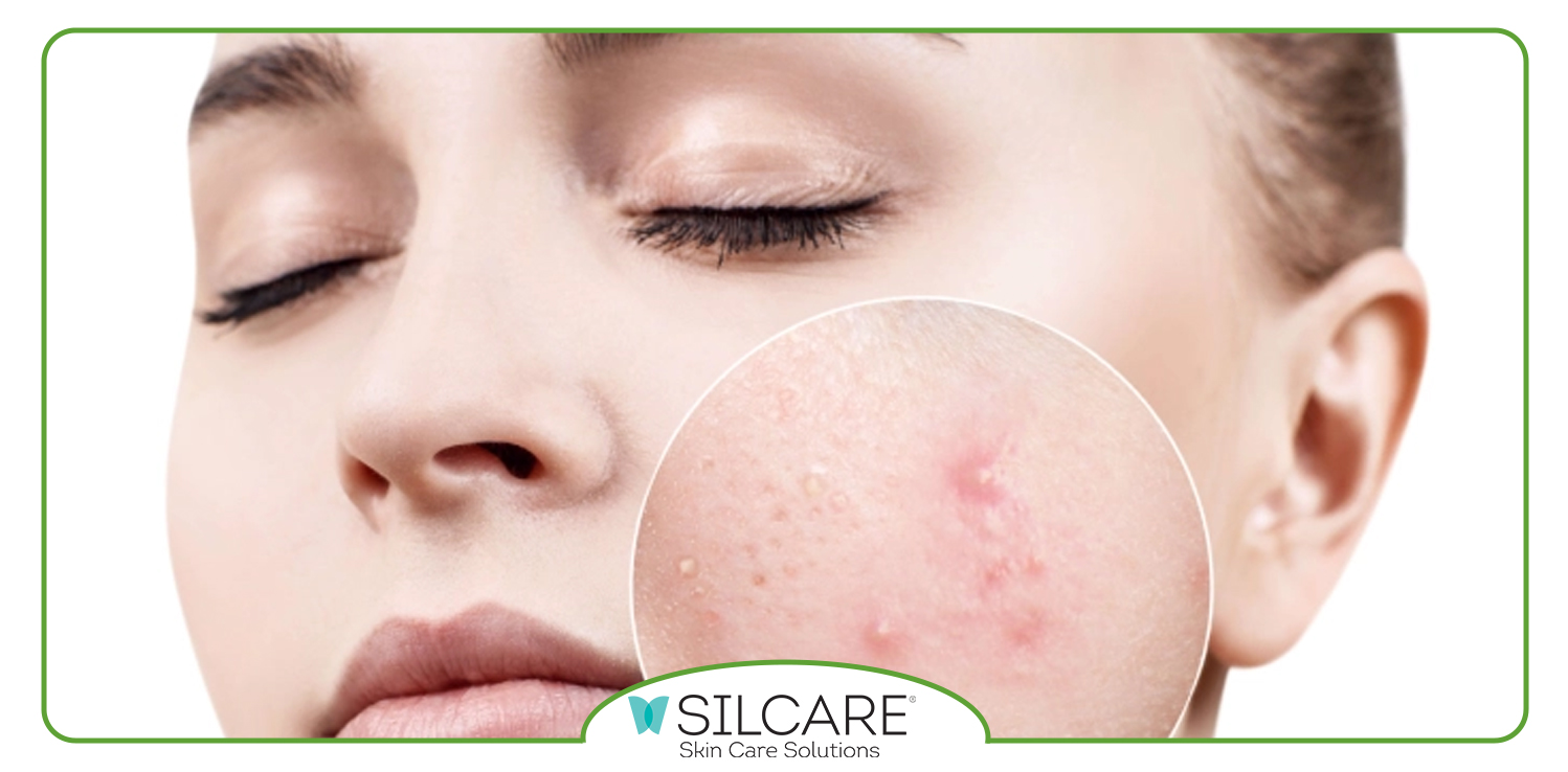 تونر پوست چرب سیلکر چگونه منافذ باز را کاهش می دهد؟