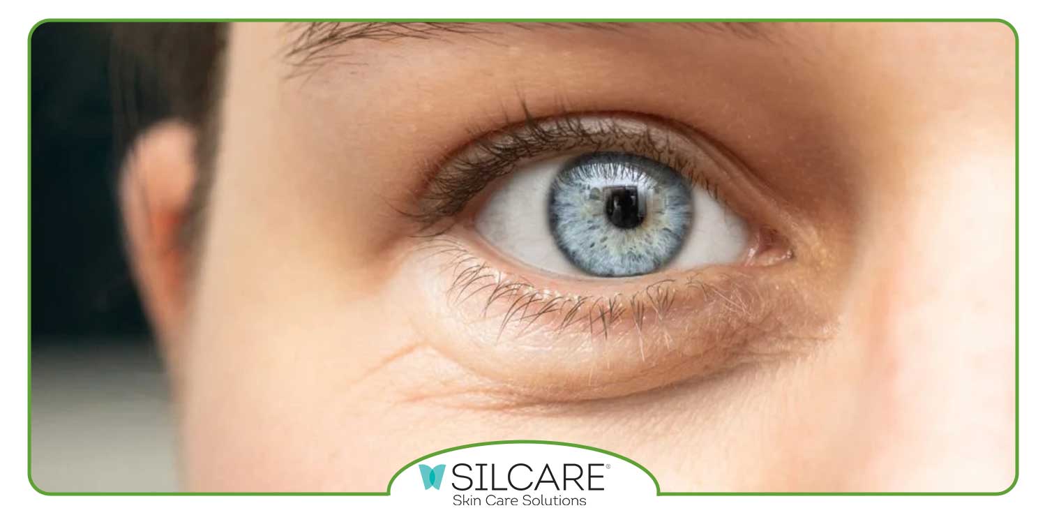 رابطه پف زیر چشم و قلب چیست؟