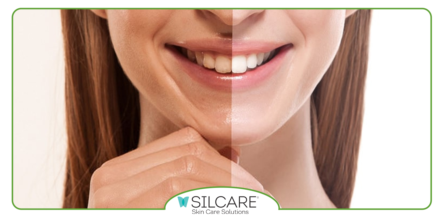 سفید شدن پوست سبزه در یک روز