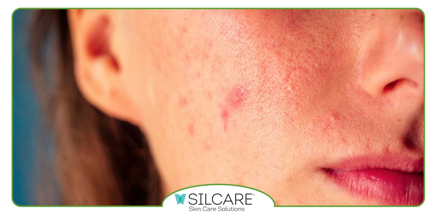 کرم از بین بردن لکه های قهوه ای جای جوش