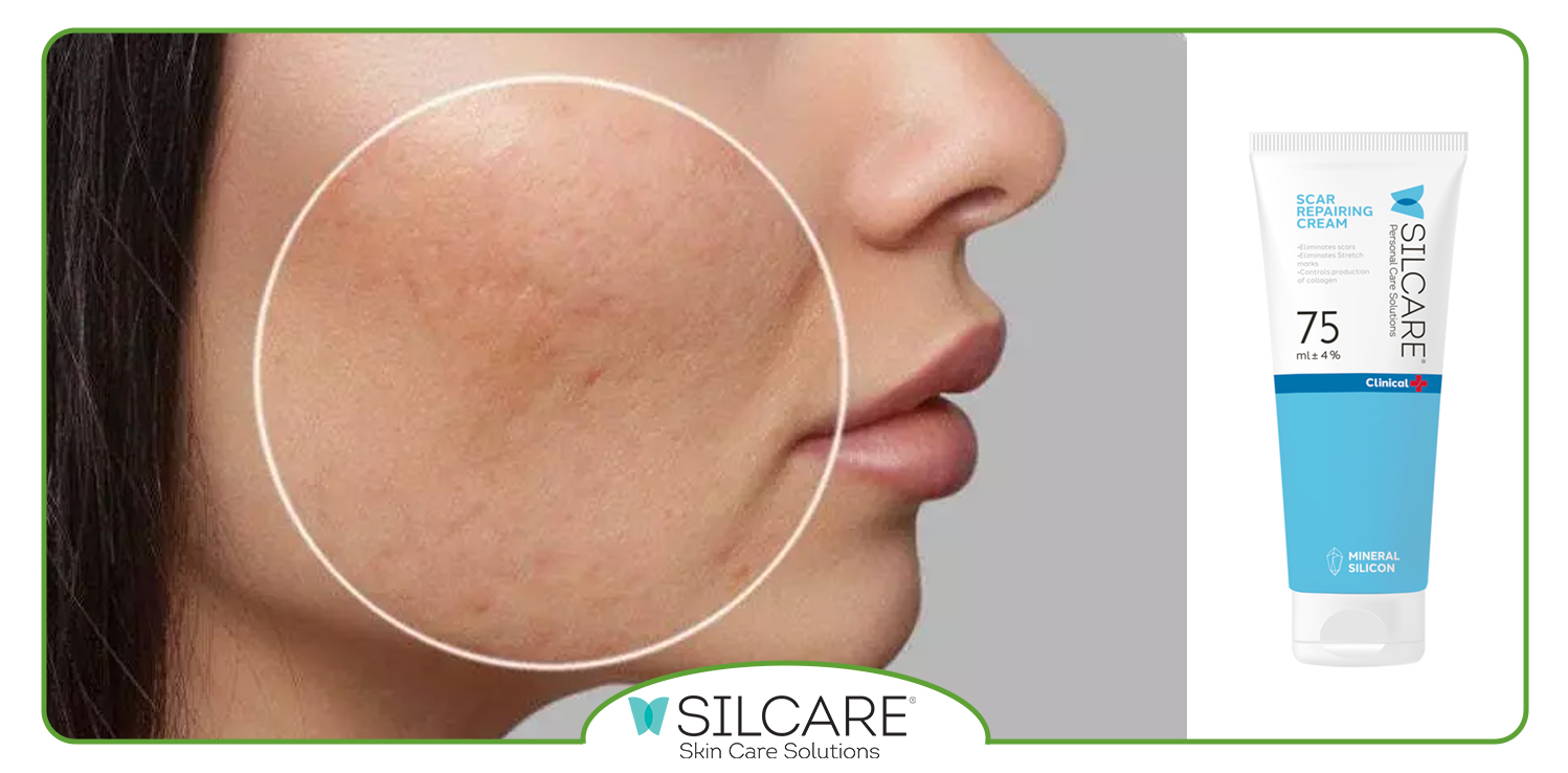 کرم ترمیم کننده فرورفتگی جای جوش