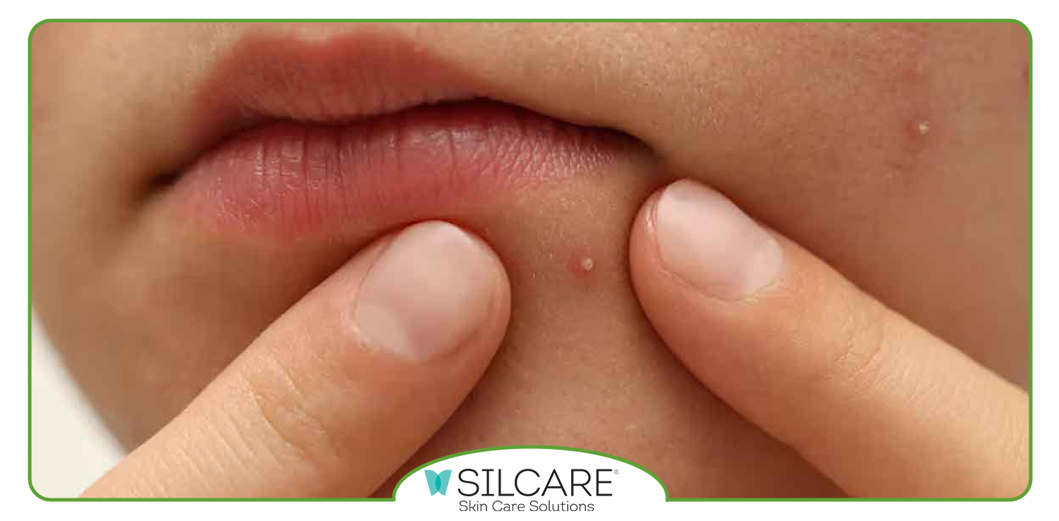 از بین بردن جوش صورت در یک روز