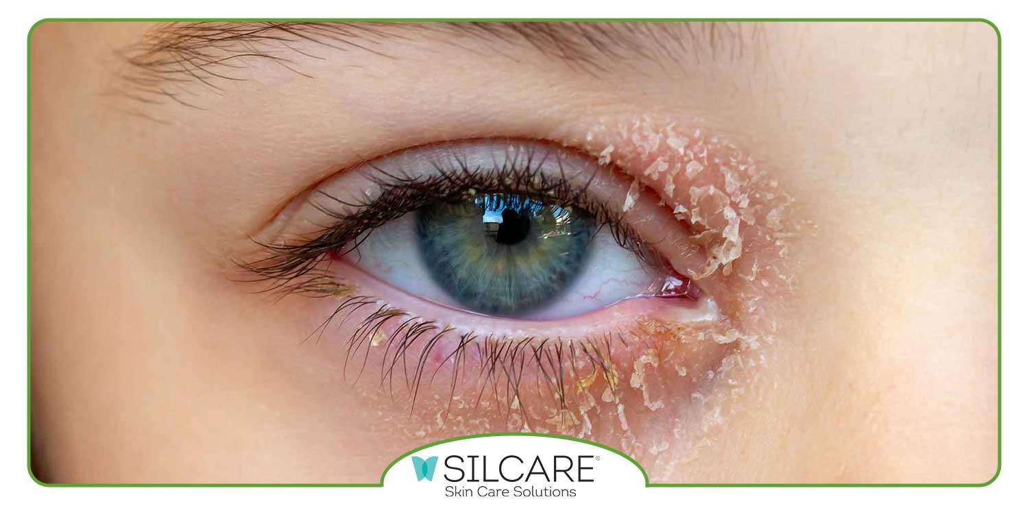 برای خشکی پوست زیر چشم چه باید کرد؟