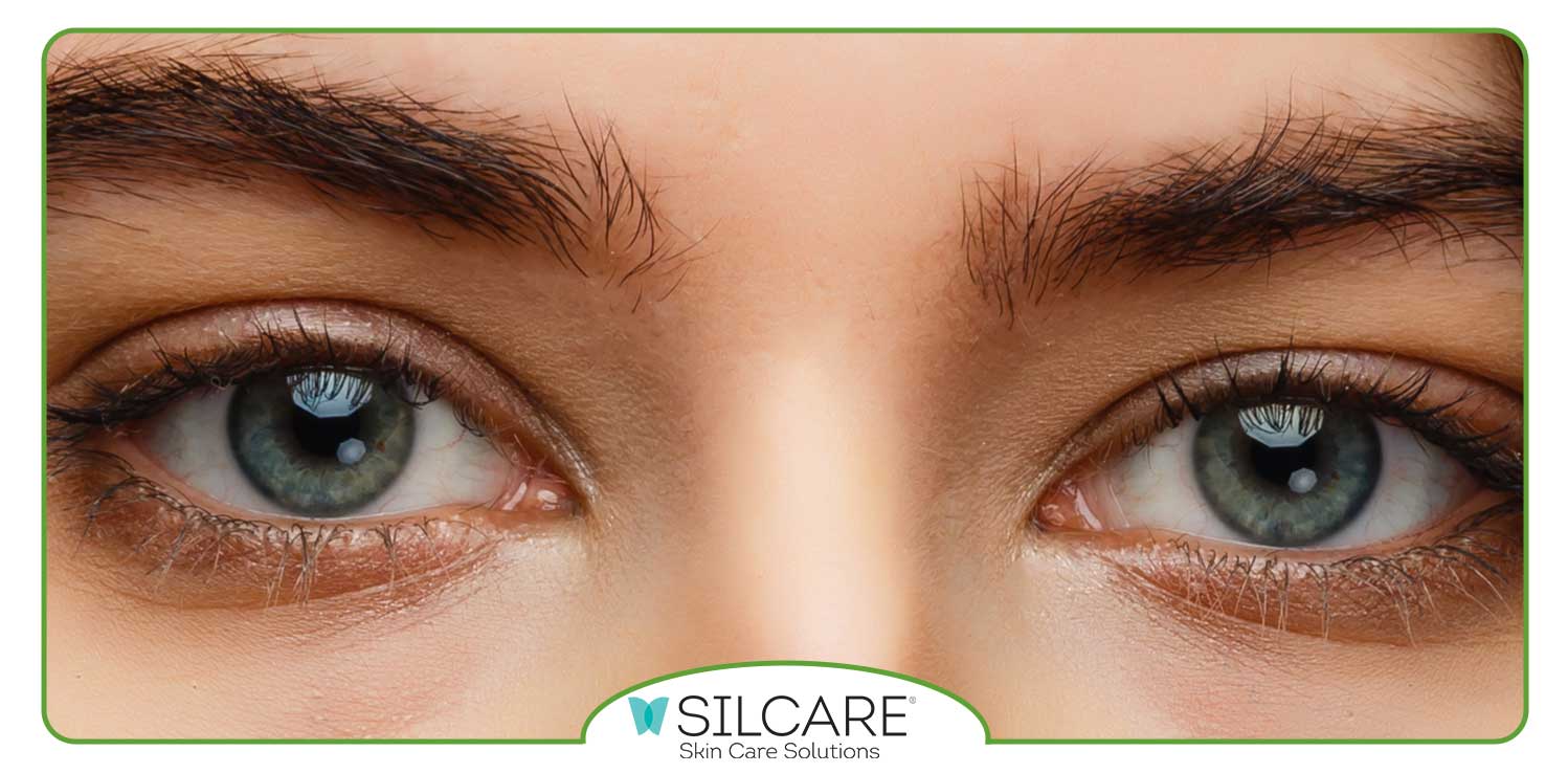 خشکی شدید پوست اطراف چشم‌