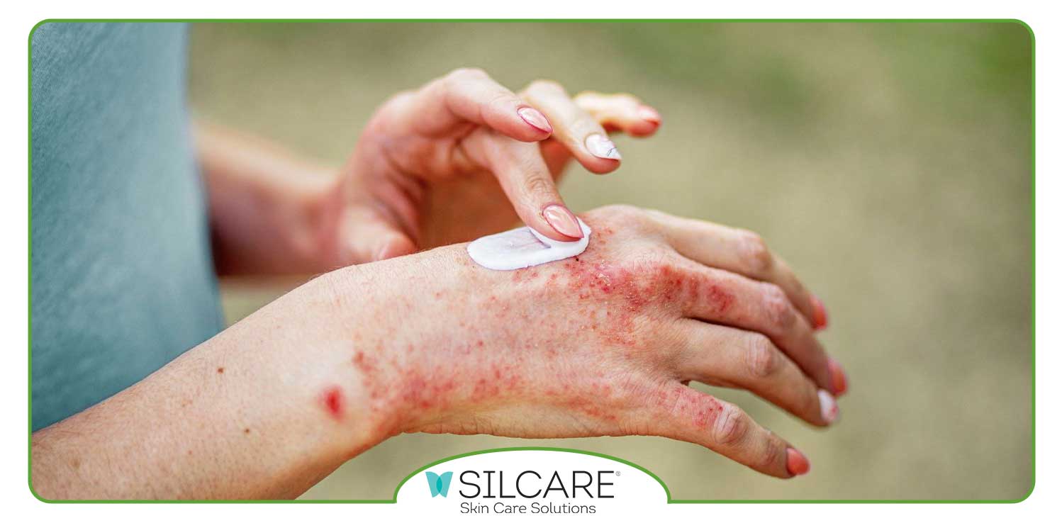 چه زمانی باید از کرم ضد اگزما استفاده کرد؟