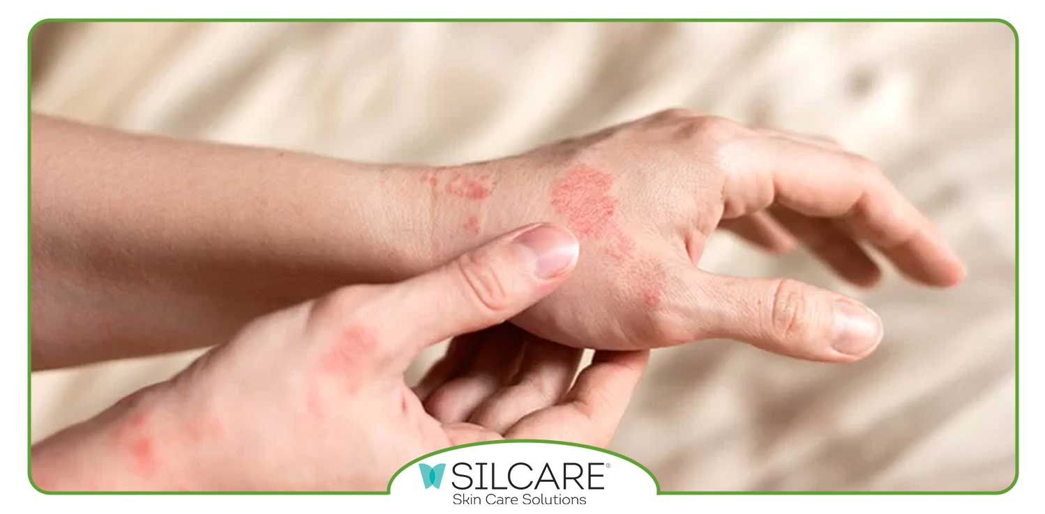 چه پمادی برای اگزمای پوستی خوب است؟