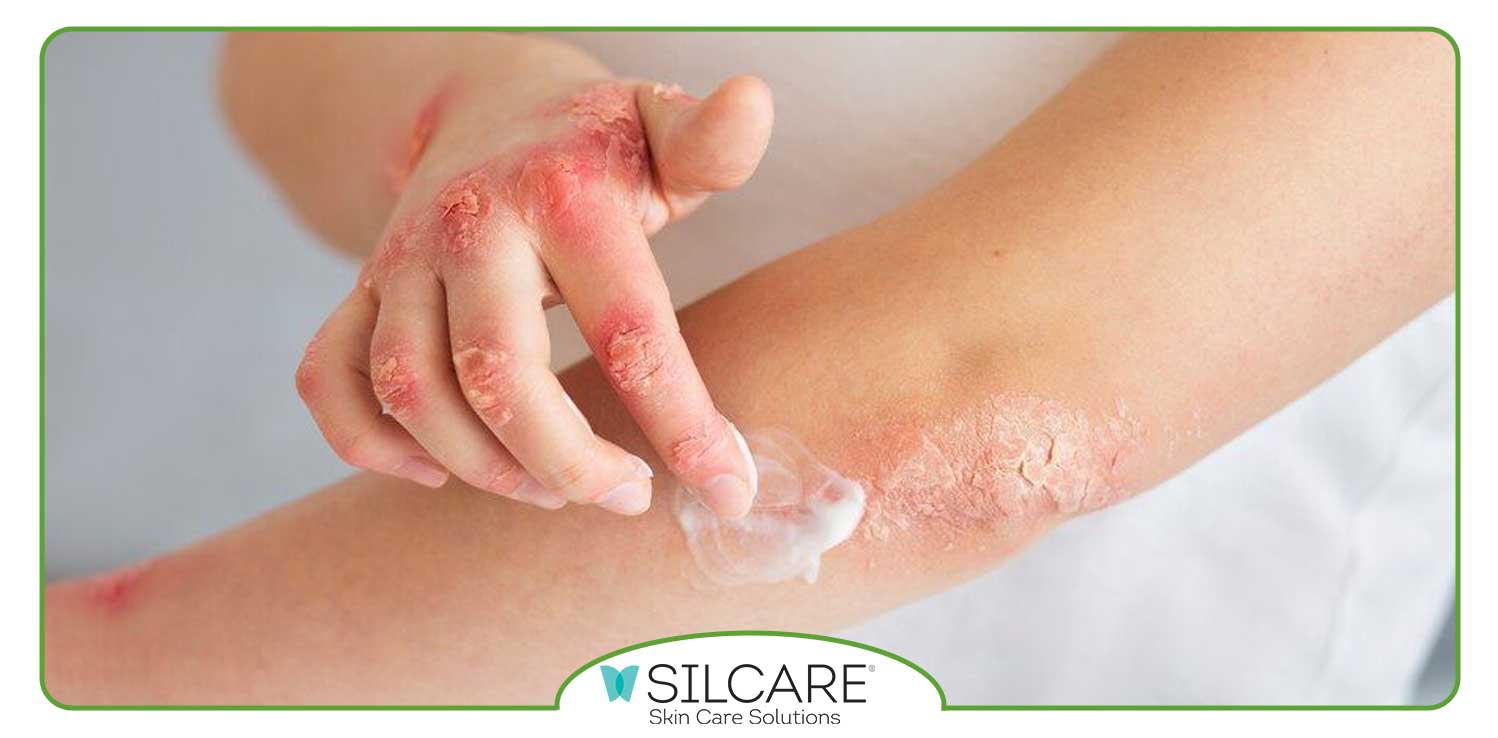 کدام نوع پماد ها برای اگزما موثرترین هستند؟