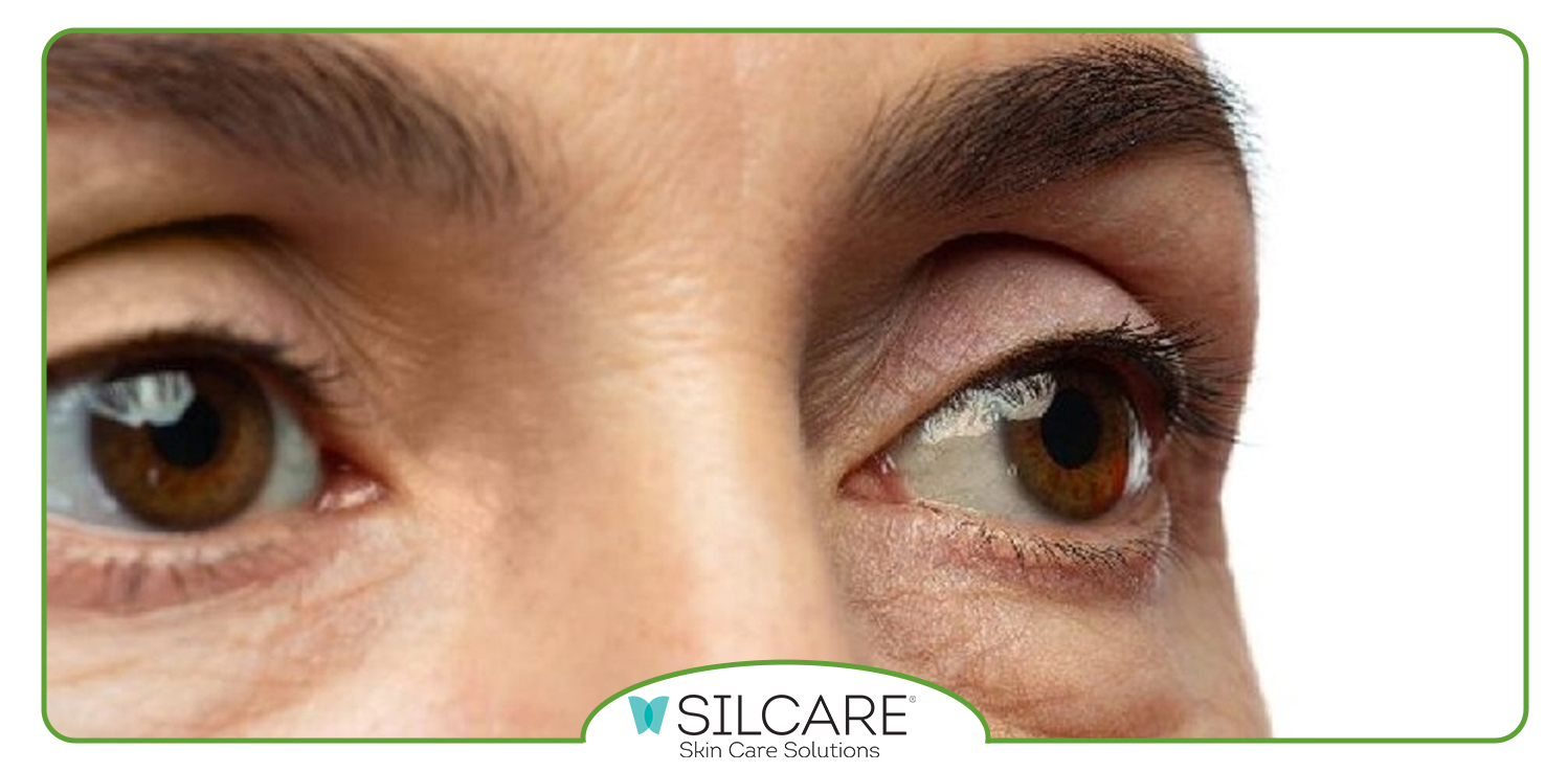 ارتباط بین سیاهی دور چشم و کلیه