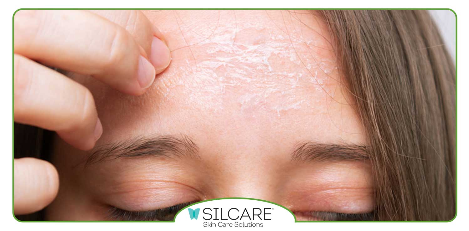 برای خشکی و پوسته پوسته شدن صورت چه کنیم؟