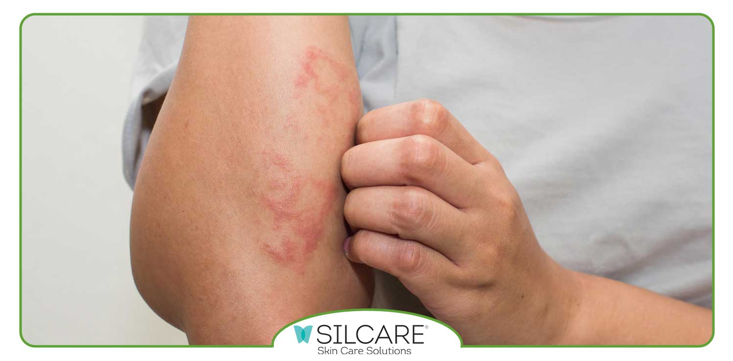 برای رفع اگزمای پوستی چه باید کرد؟