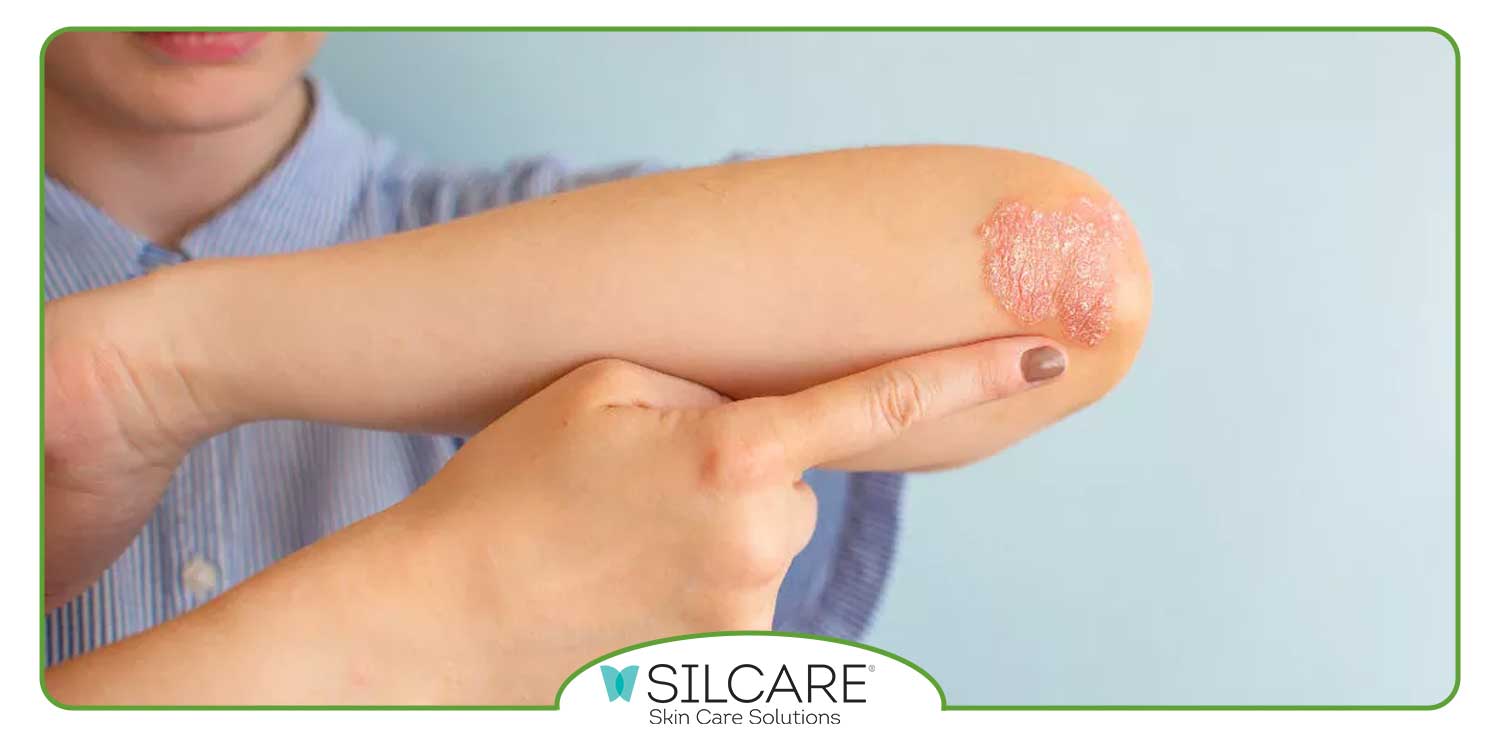 برای رفع پسوریازیس چی بخوریم؟