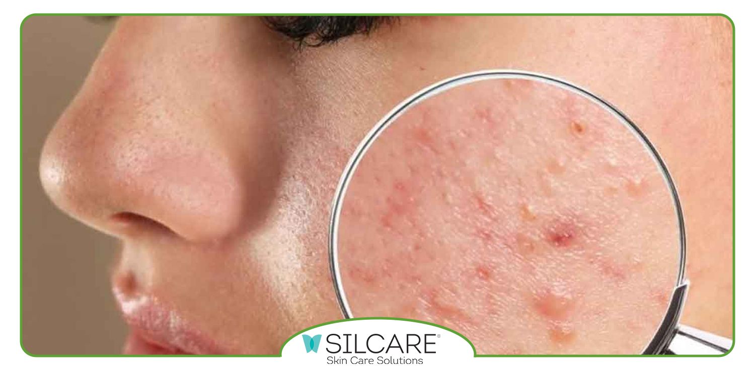 بهترین سرم برای ضد جوش برای پوست خشک