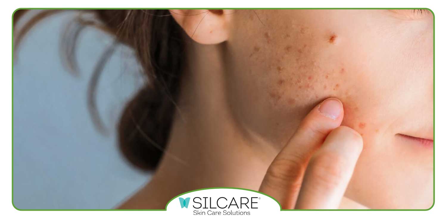 بهترین پماد برای درمان جوش های صورت کدام است؟