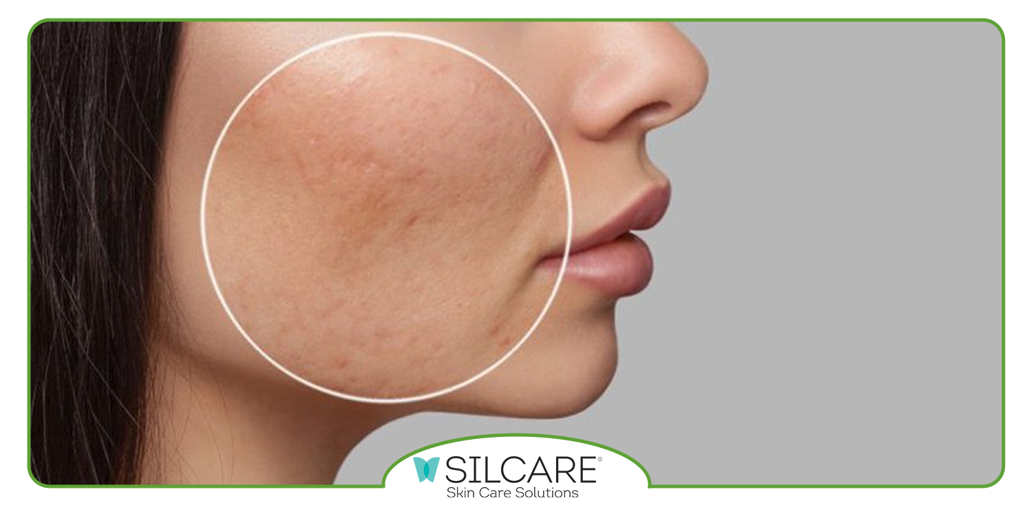 بهترین کرم ترمیم کننده بعد از لیزر