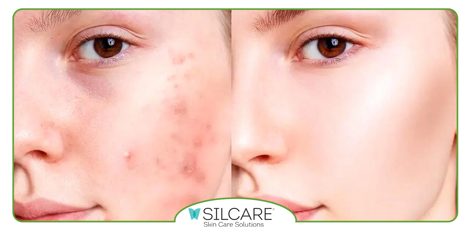 بهترین کرم ضدجوش و سفید کننده