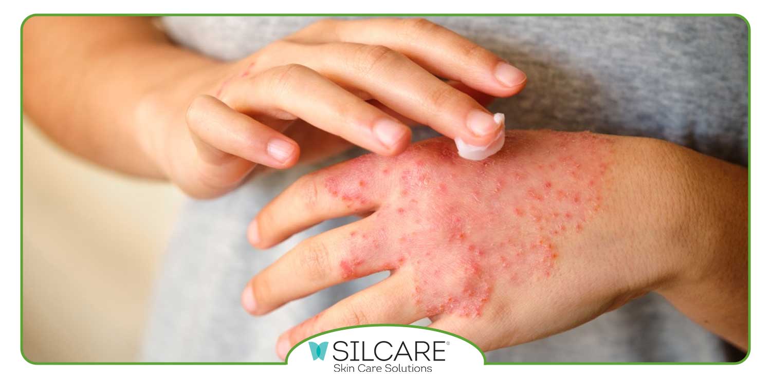 رفع علائم اگزما با کرم ترمیم کننده سیلکر