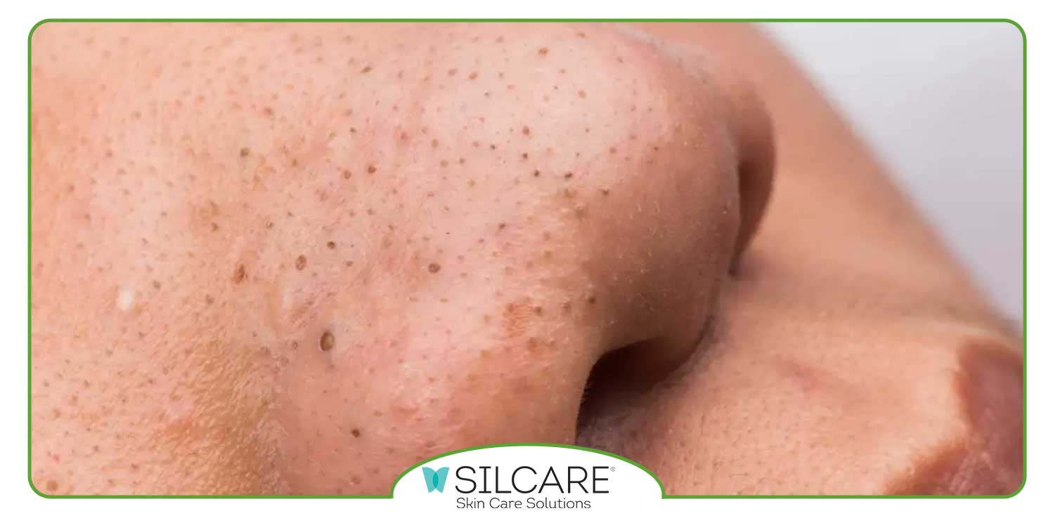 سریع ترین راه برای از بین بردن جوش های سرسیاه