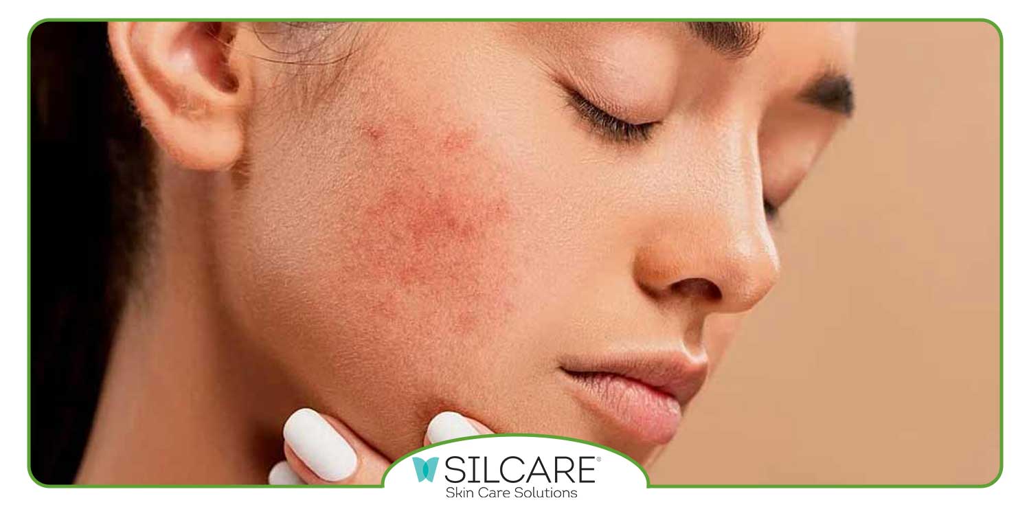 پماد برای از بین بردن سریع جوش صورت