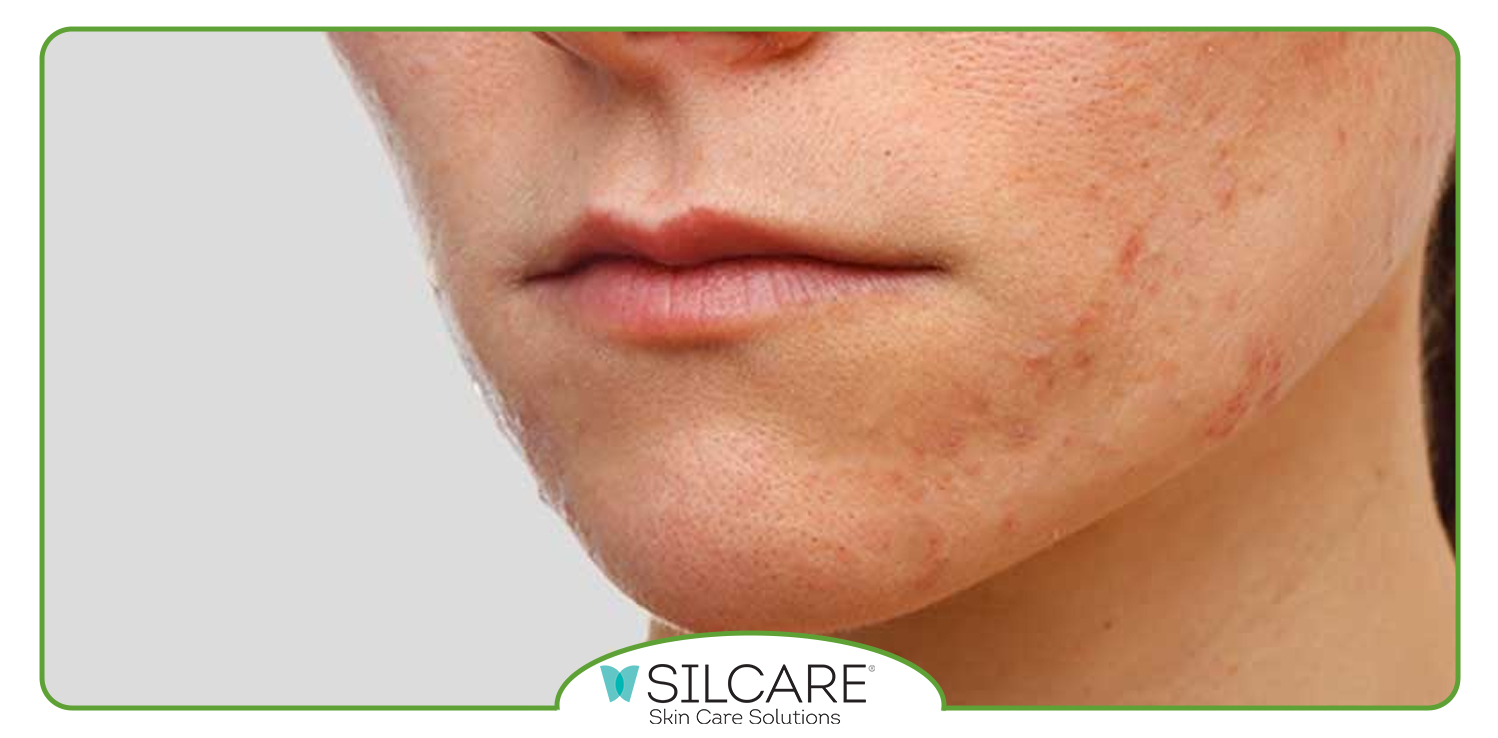 پماد برای رفع خارش پوستی در بارداری