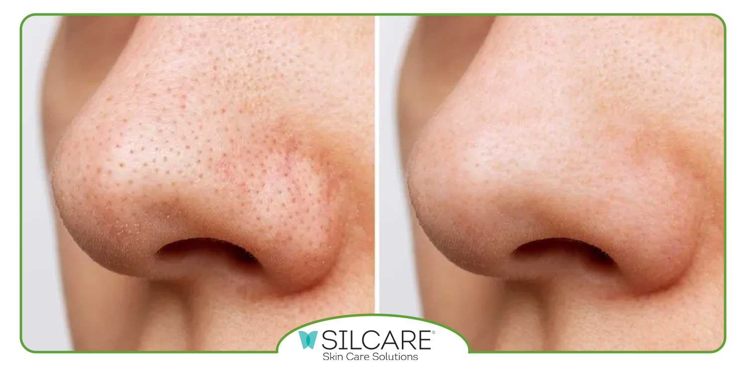 چه چیزی باعث ایجاد جوش های سرسیاه می شود؟