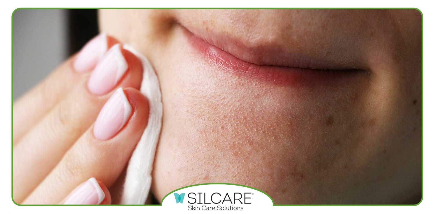 چگونه جوش های سرسیاه را از بین ببریم؟