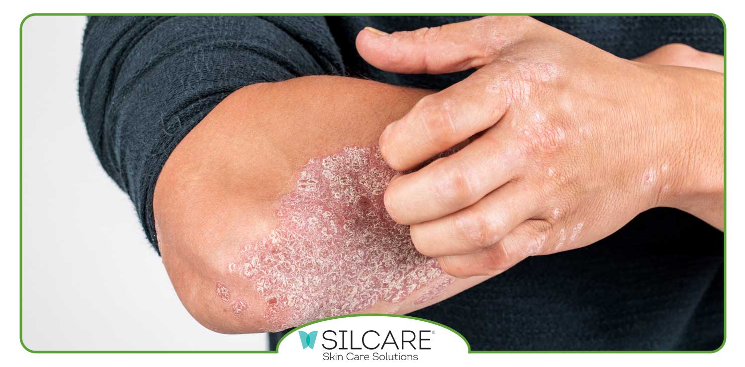 کاهش التهاب پسوریازیس با استفاده از کرم و ژل های ترمیم کننده
