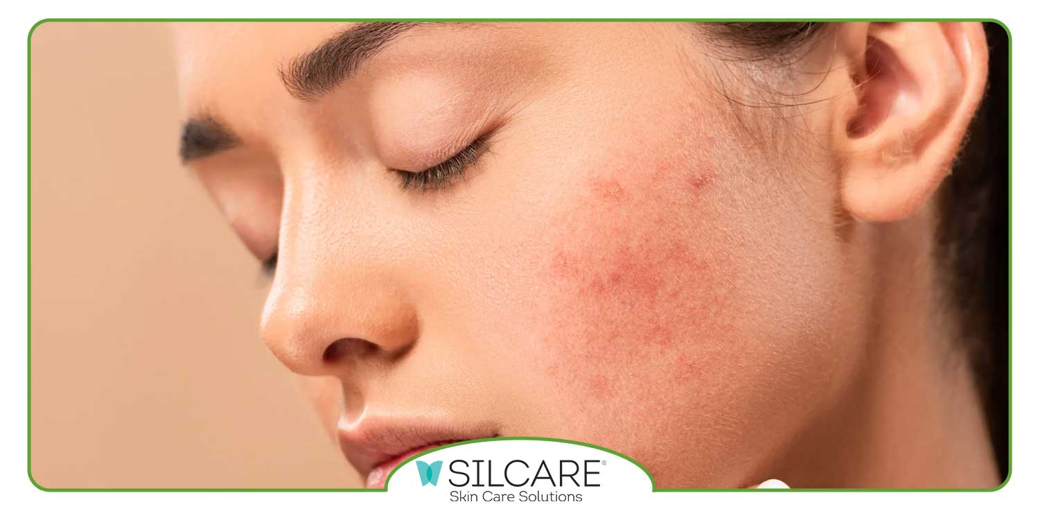 استفاده از محصولات ملایم برای مراقبت از پوست