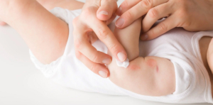 کاهش علائم اگزمای نوزادان با روغن آفتابگردان