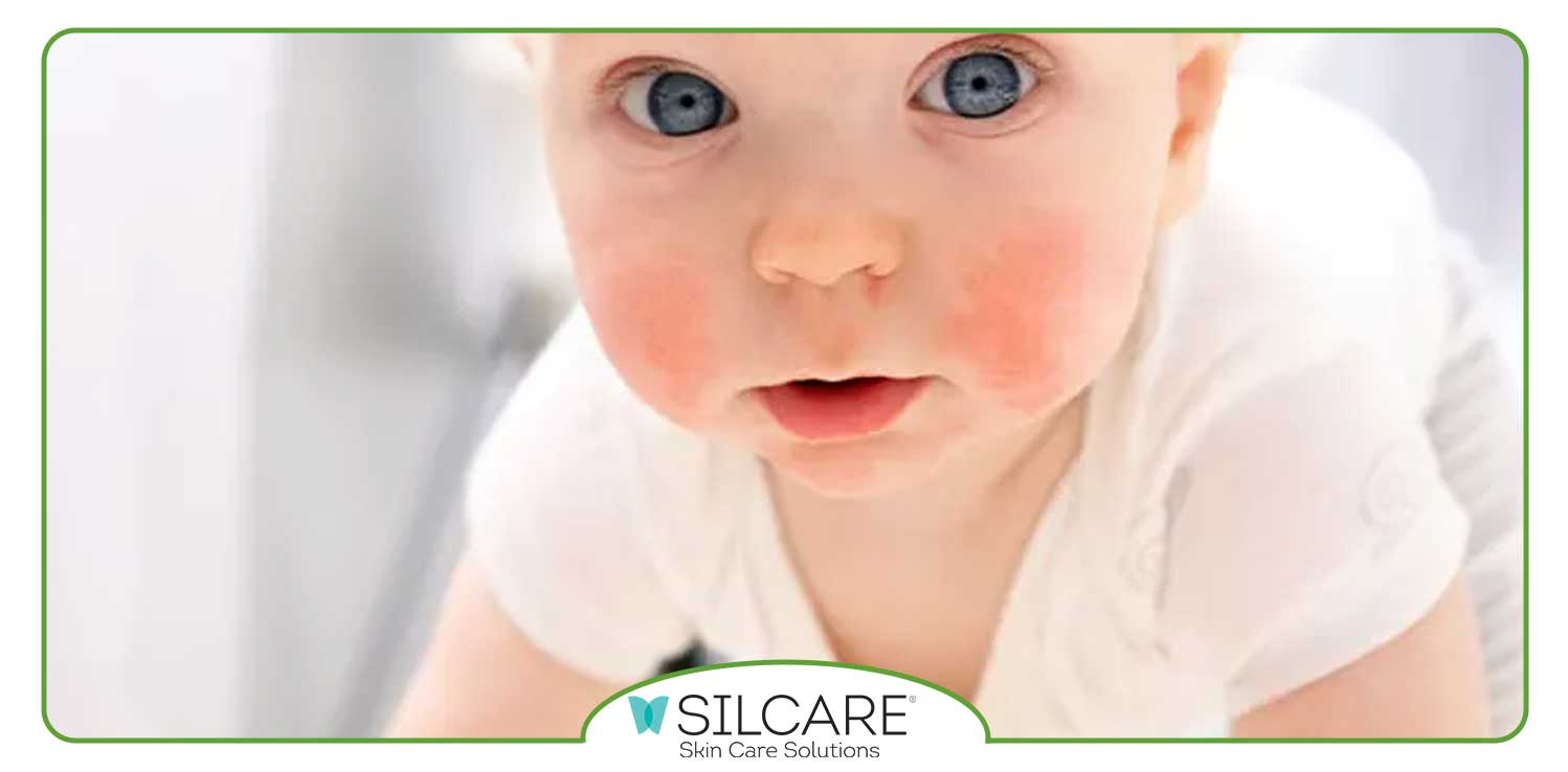 برای قرمزی پوست صورت نوزاد چه باید کرد؟