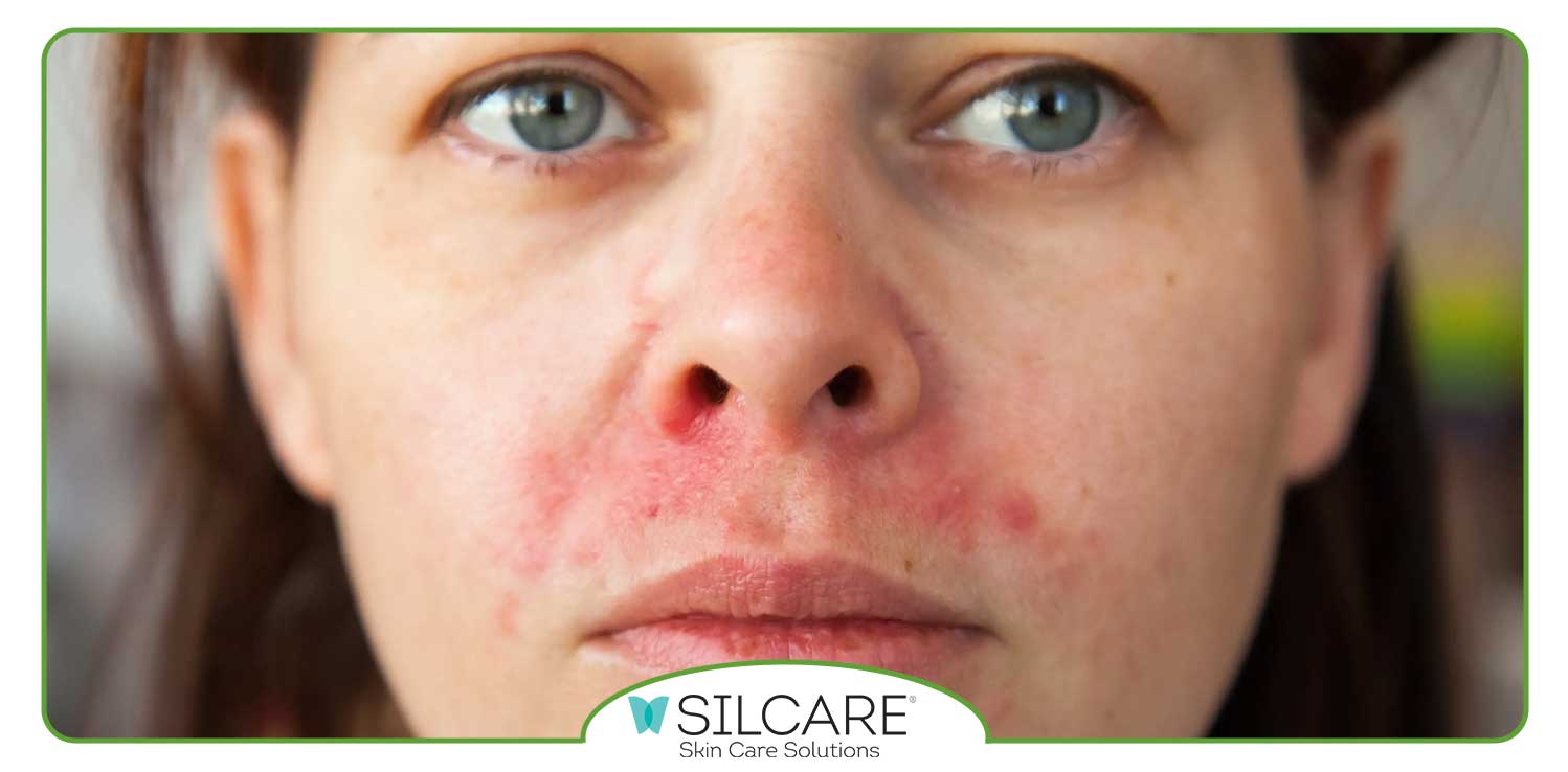 بهترین پماد برای اگزمای پوستی صورت و گردن