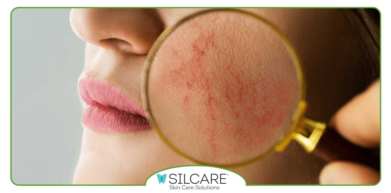 بهترین کرم برای التهاب و قرمزی پوست صورت