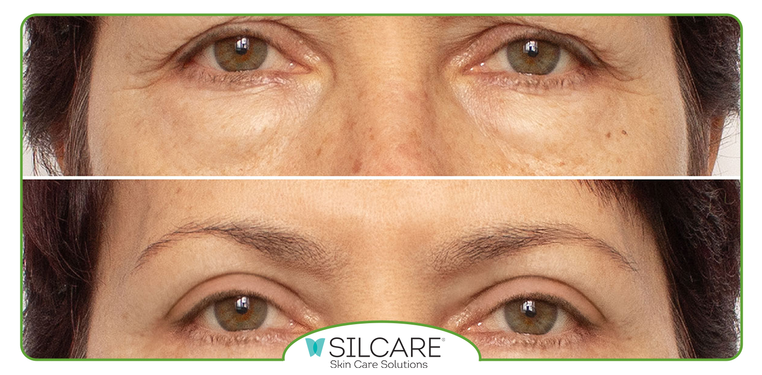 تاثیر استفاده از ترمیم کننده بعد از عمل بلفاروپلاستی