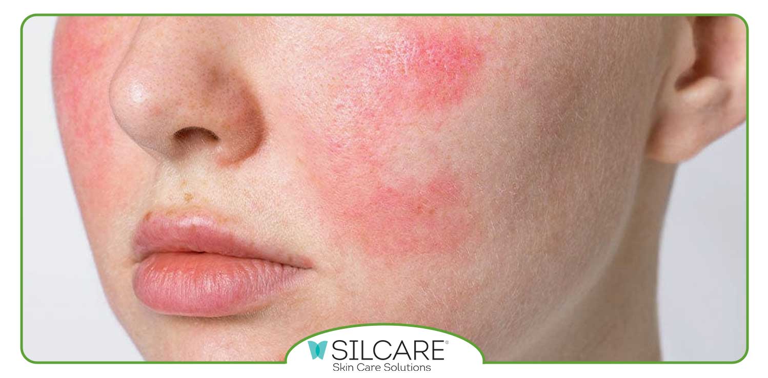 سریع ترین راه حل برای از بین بردن قرمزی صورت