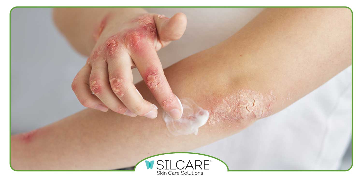 چه پمادی برای بیماری پسوریازیس خوب است؟