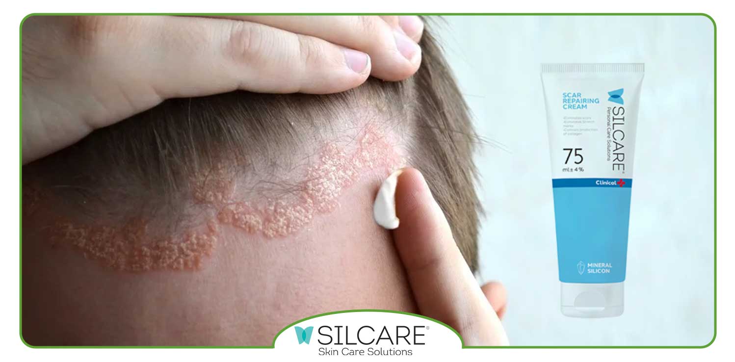 چه چیزی باعث تشدید علائم پسوریازیس می شود؟