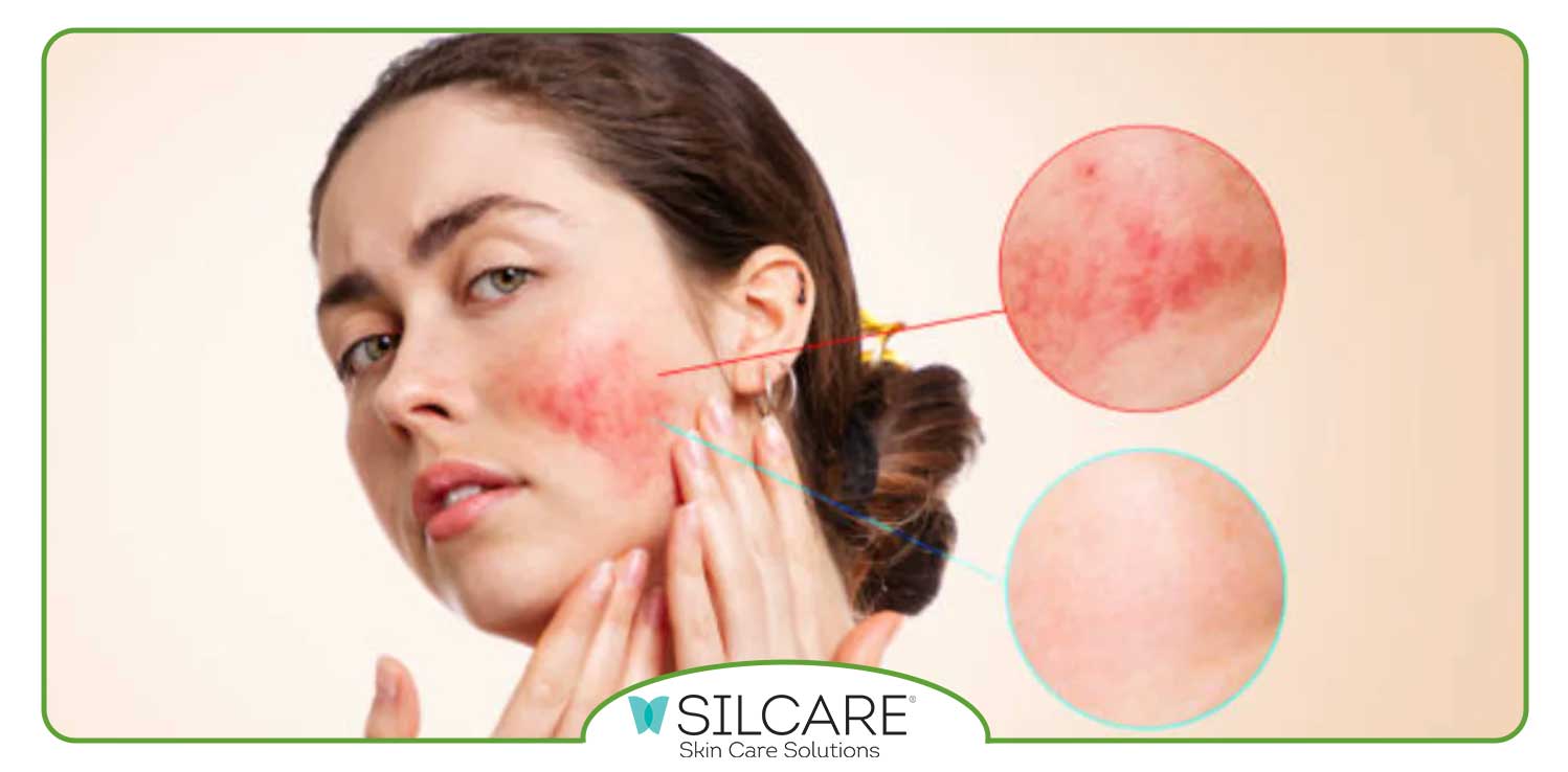 چگونه می توان از قرمزی صورت جلوگیری کرد؟