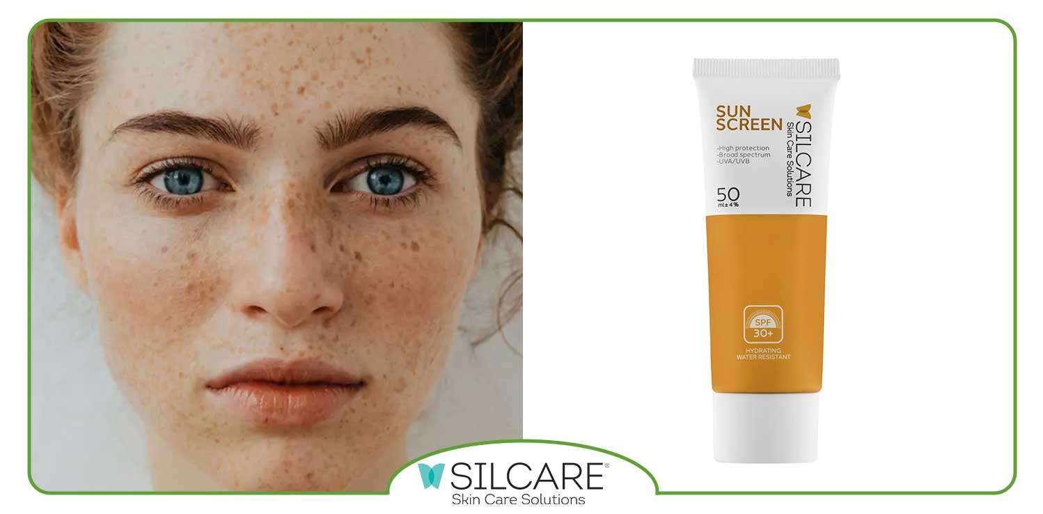 انتخاب کرم ضد آفتاب مناسب برای پوست مستعد کک و مک