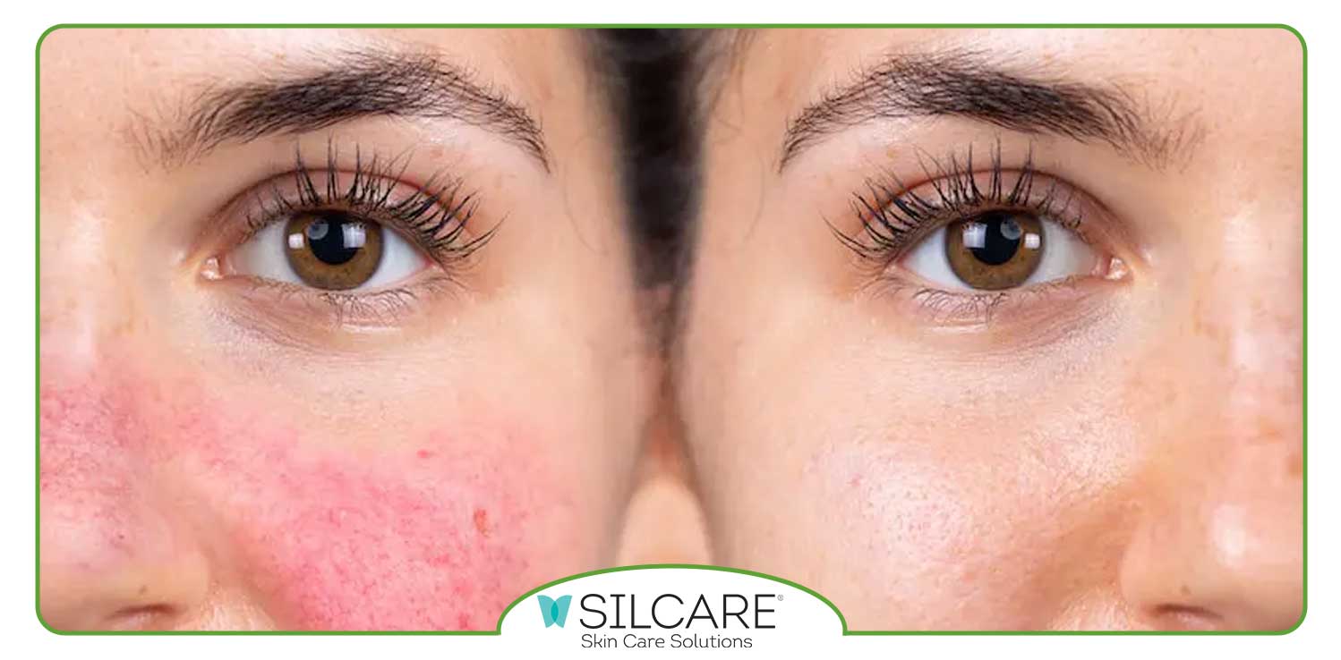 برای سوزش و قرمزی پوست صورت چه کنیم؟