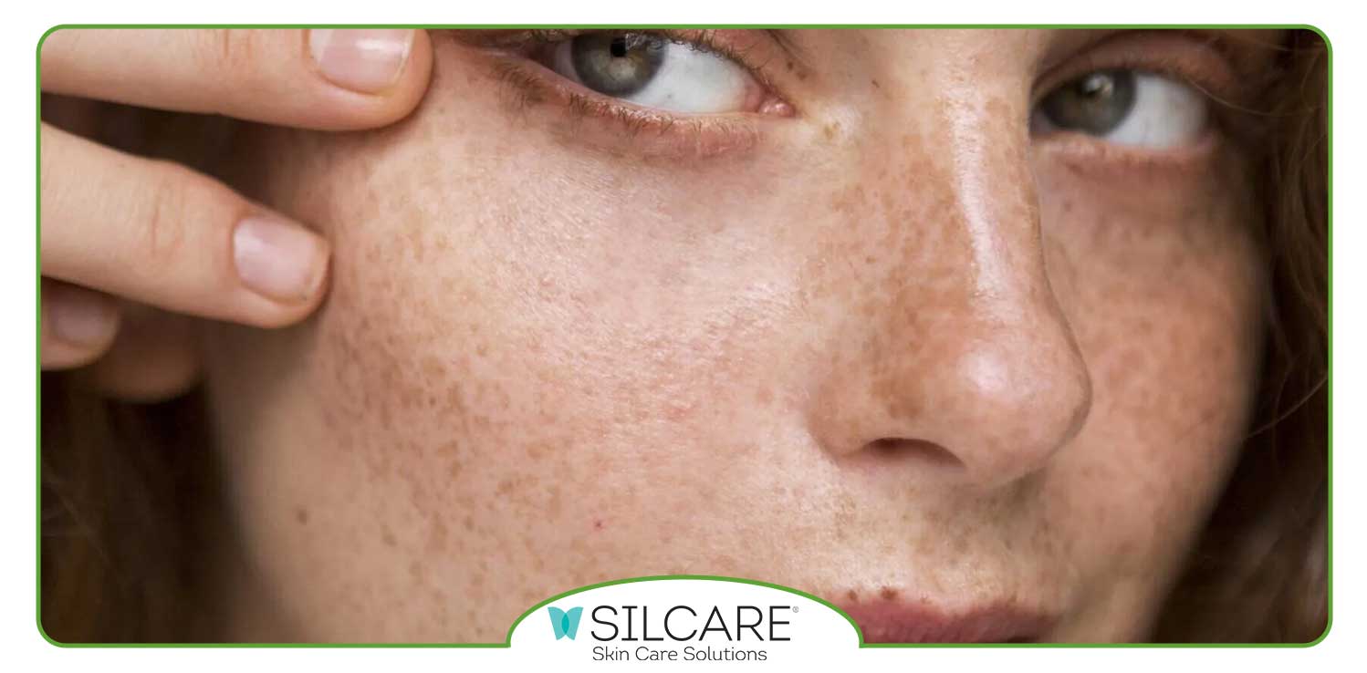 بهترین کرم ضد آفتاب برای لک صورت