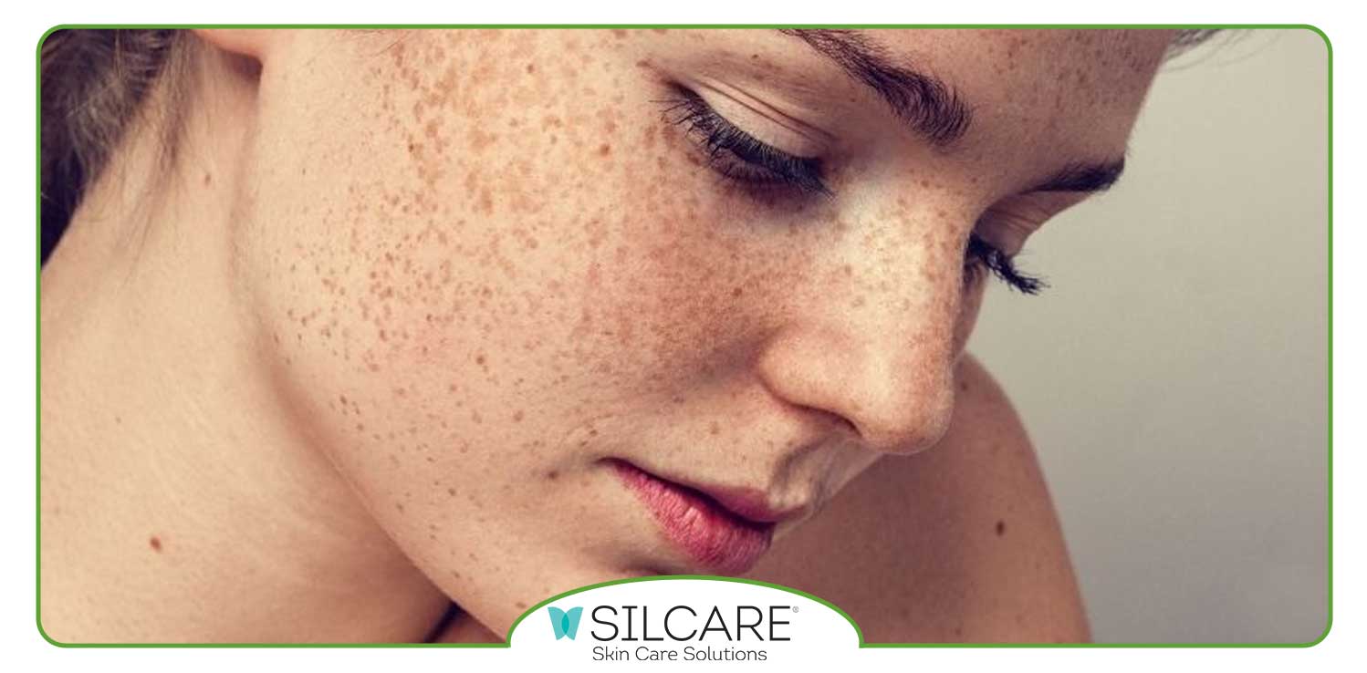 بهترین کرم ضد آفتاب برای کک و مک