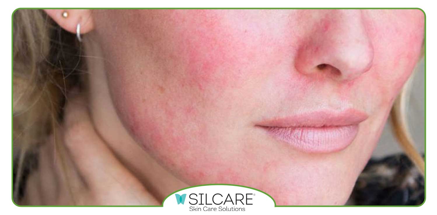 دلایل مختلف قرمزی و التهاب پوست صورت