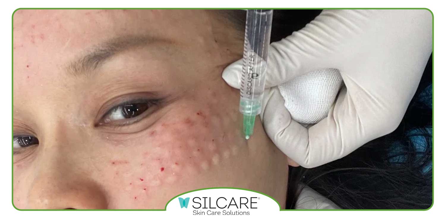 رفع کبودی بعد از مزوتراپی