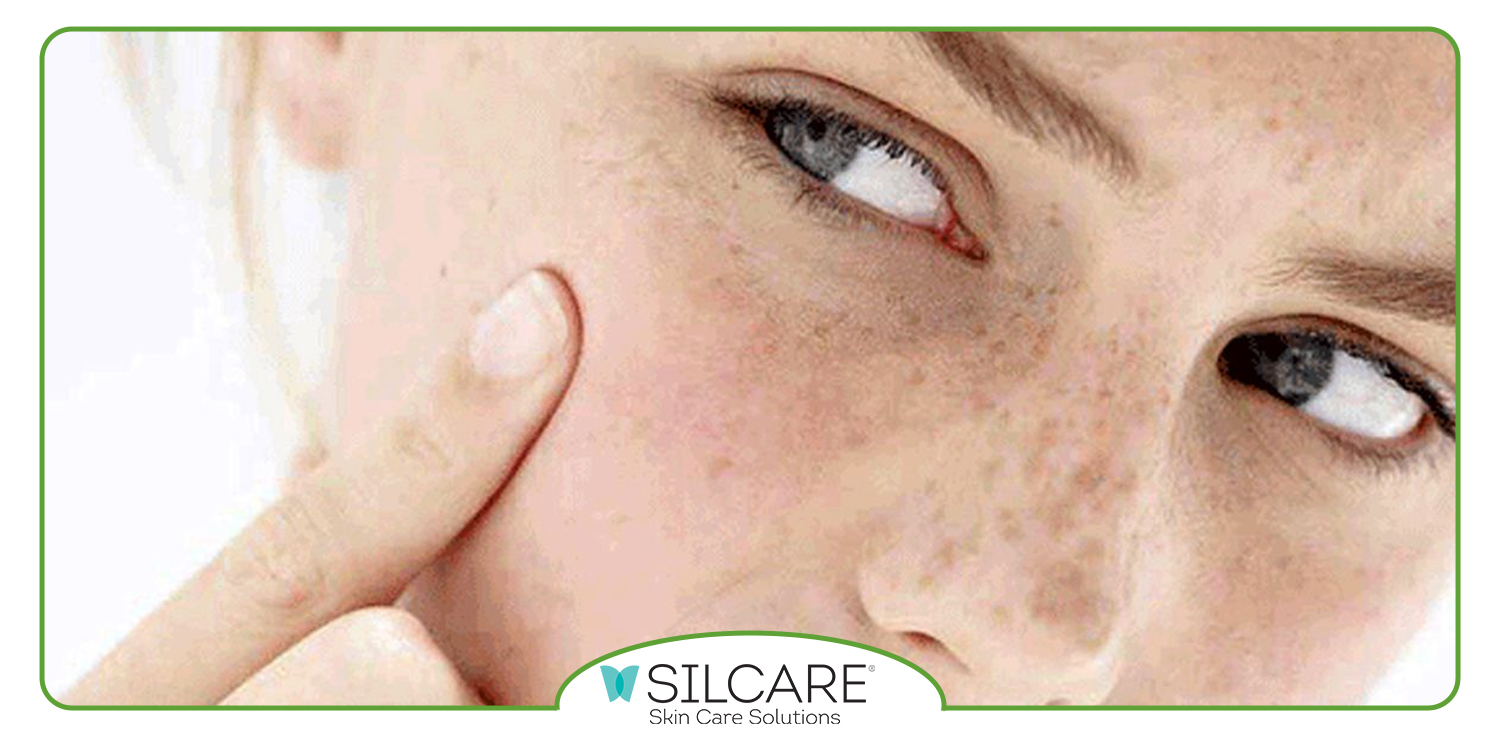 بهترین زمان برای استفاده از سرم ضدلک سیلکر