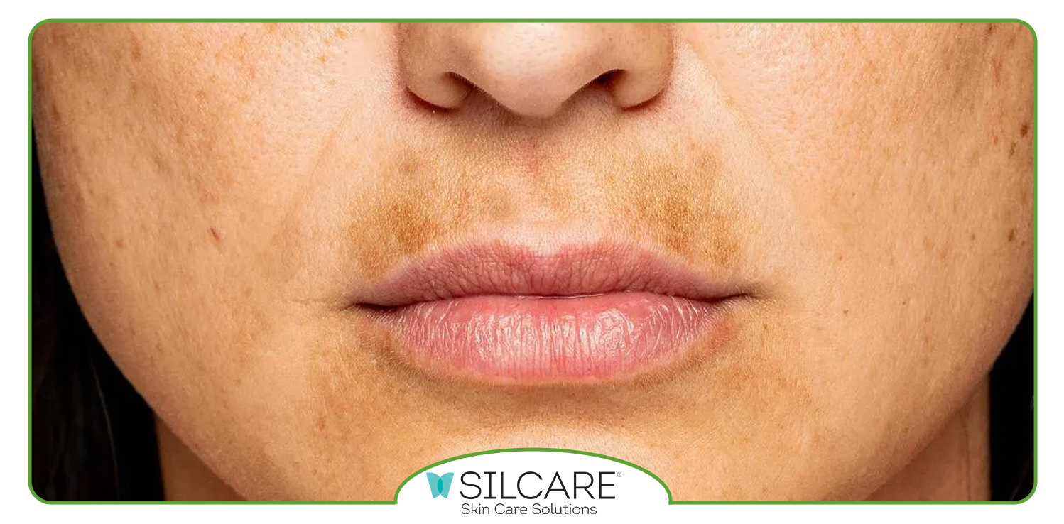 سرم ضدلک سیلکر چیست و چگونه عمل می‌ کند؟