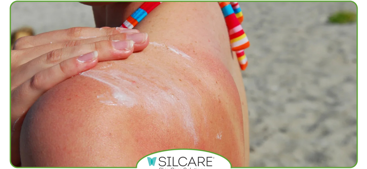 فرق اسپری آفتاب‌ سوختگی با ژل‌ های ترمیمی چیست؟