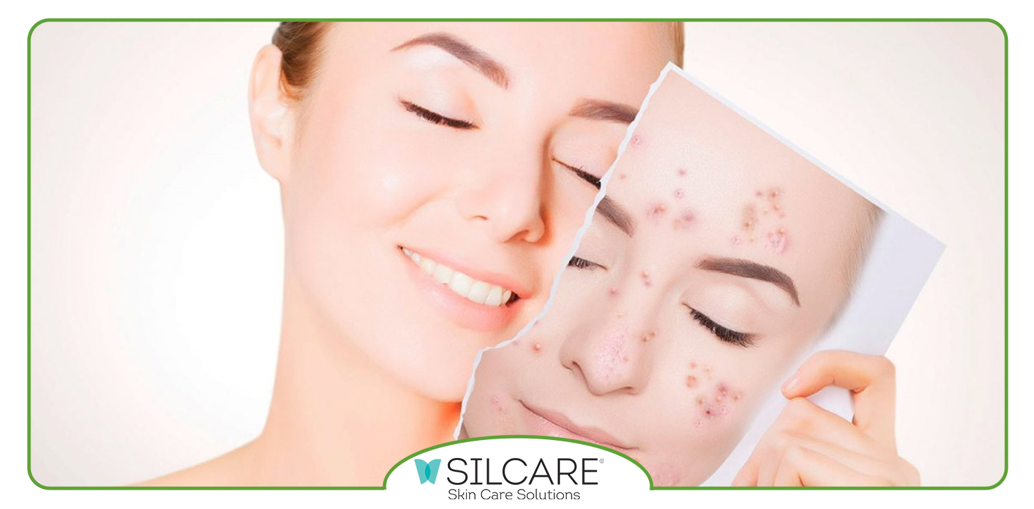 چگونه با سرم ضدلک سیلکر پوست شفاف تری داشته باشیم؟