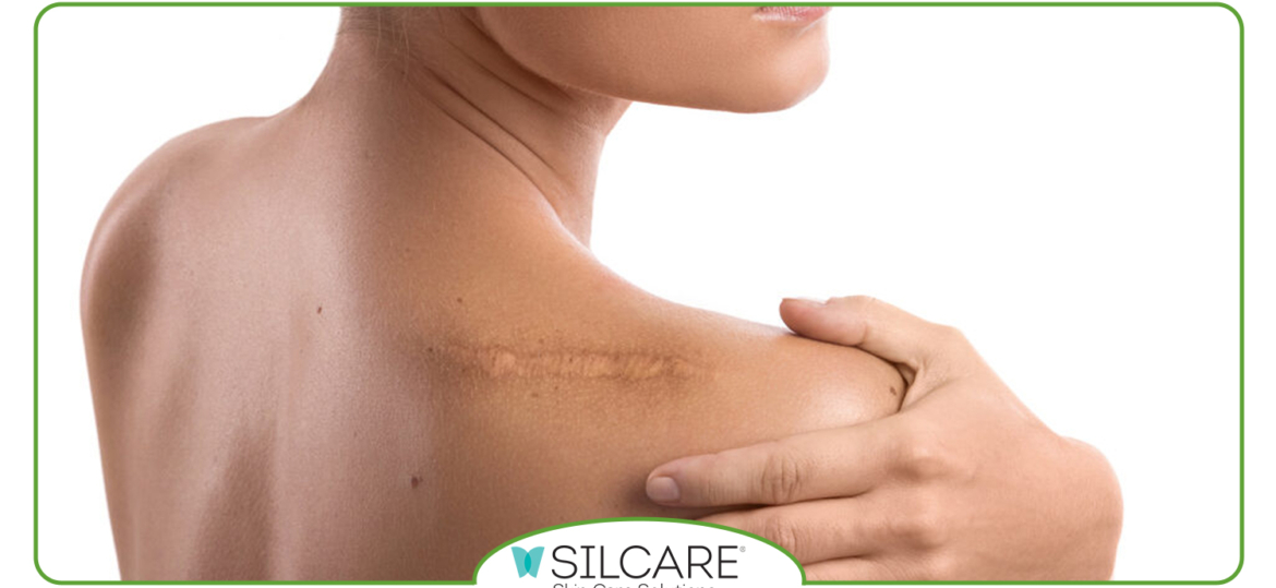 چگونه کرم ترمیمی سیلکر به بهبود جای زخم کمک می کند؟