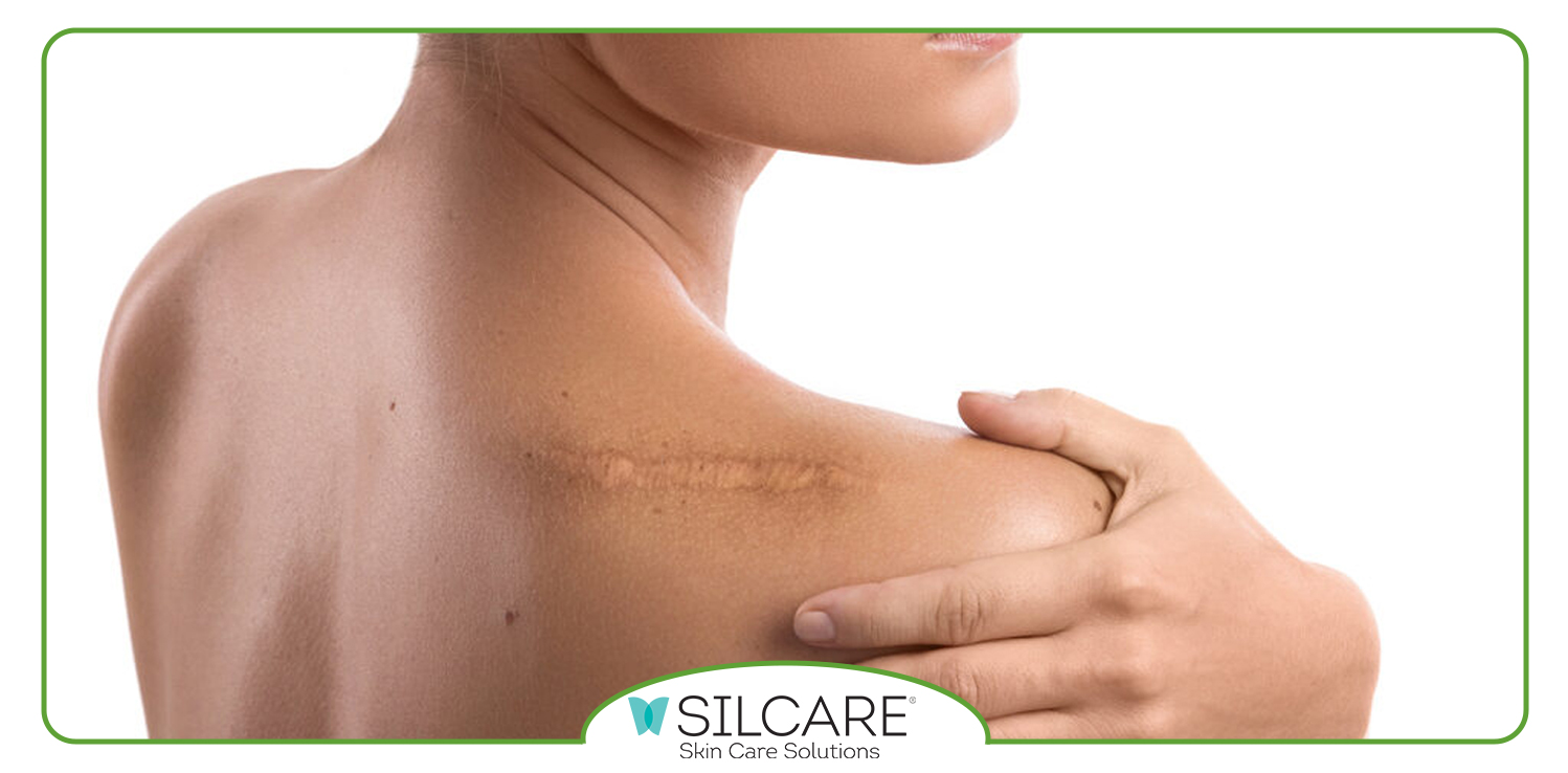 چگونه کرم ترمیمی سیلکر به بهبود جای زخم کمک می کند؟