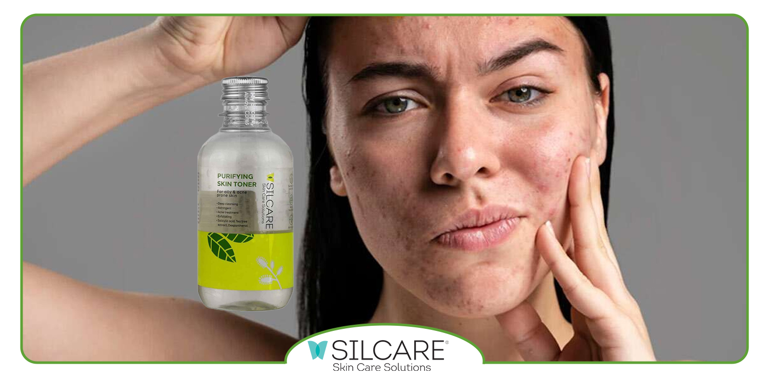 بهترین تونر برای پوست چرب و جوش دار